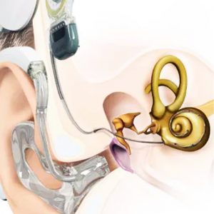 Fler patienter får hörselbevarande implantat på Akademiska