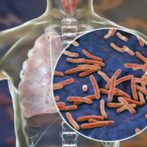 Uu: ”Dödlig” mutation gjorde tuberkulosbakterie resistent mot antibiotika